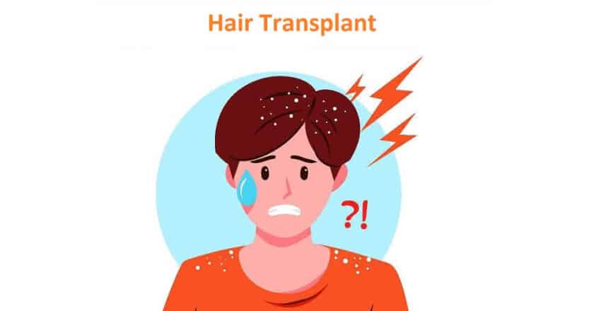 How to Get Rid of Dandruff After A Hair Transplant?